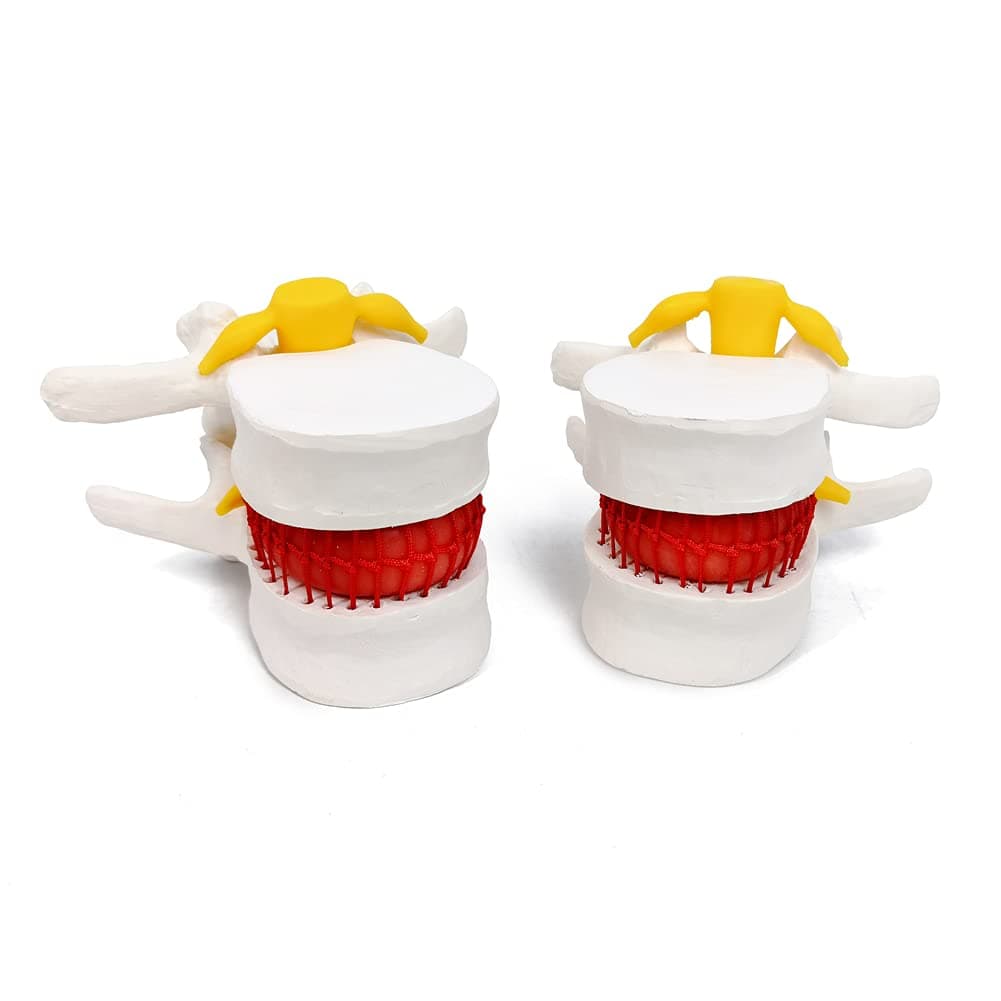 EVOTECH SCIENTIFIC Human Herniated Disc Model, Anatomical Herniated Lumbar Vertebrae Disc Prolapse Model for Medical Teaching Learning Education Display Tool 5 Pack