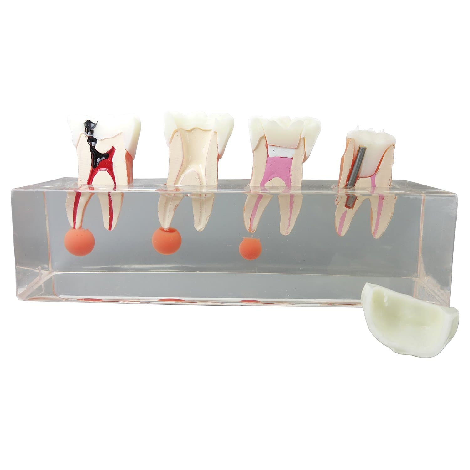 Dental Teeth Model 4-Stage Endodontic Treatment Model for Studying and Teaching …