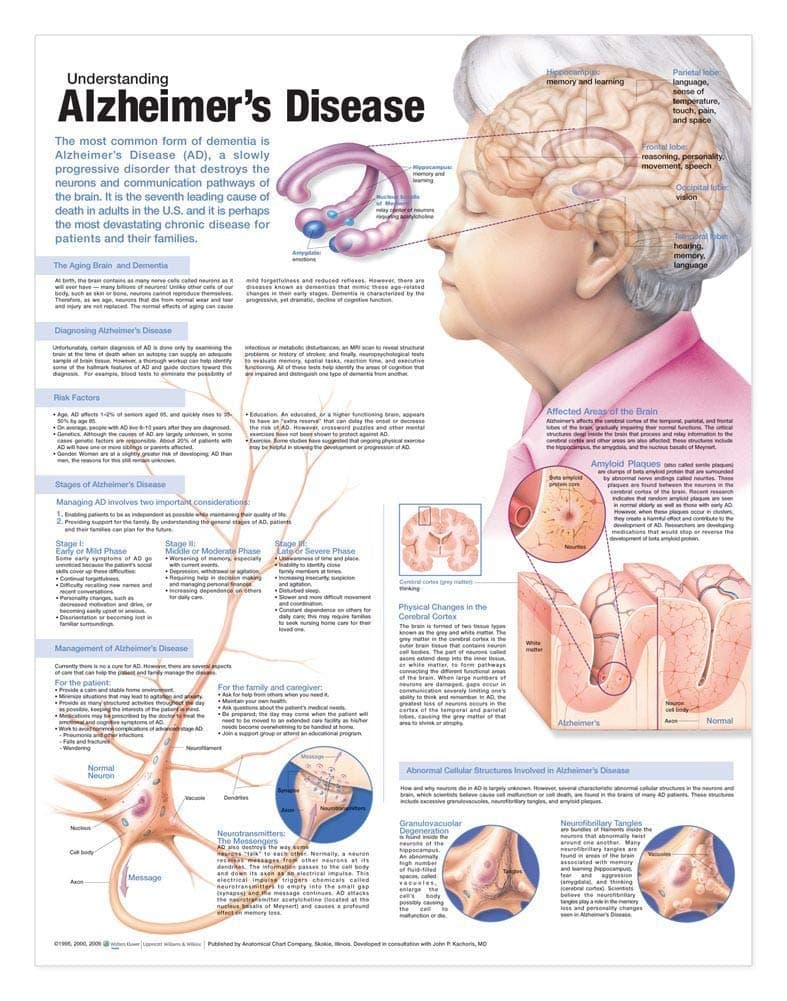 Understanding Alzheimer's Disease Anatomical Chart