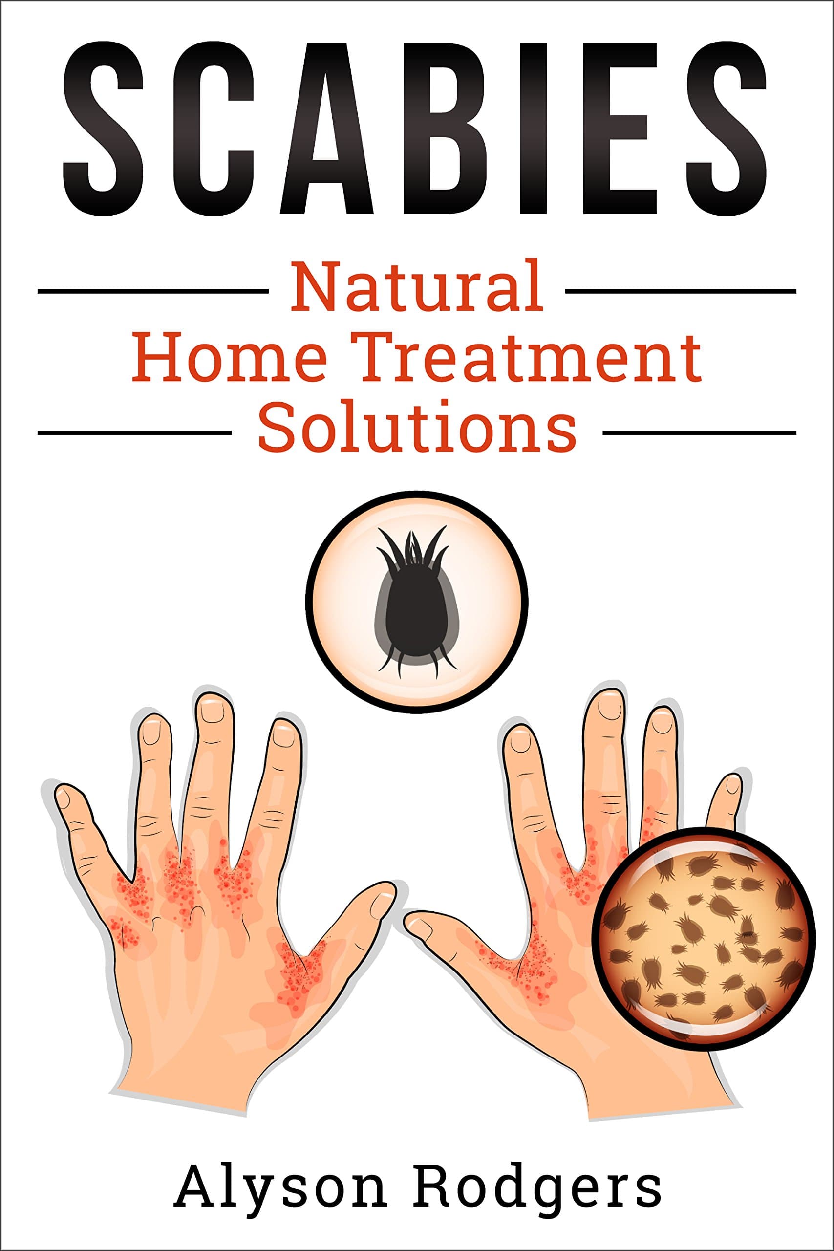 Scabies Natural Home Treatment Solution Kindle Edition